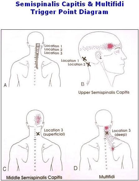 myofascial pain dental jaw